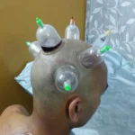 Head Hijama Cupping